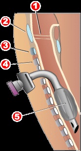 Traqueostomia.jpg