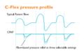 C-Flex Pressure Profile 1.PNG
