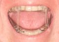 250px-Mandibular advancement splint.jpg