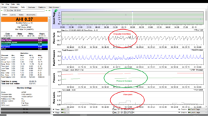 Resmed S10 Autoset Flow Limit 1.png